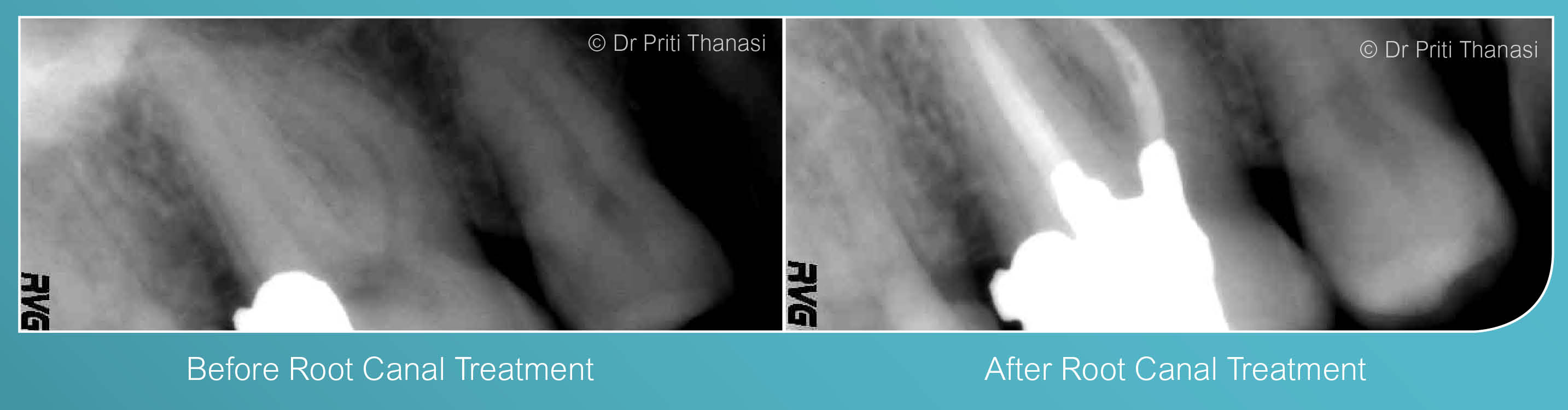 Before and after root canal treatment example 1